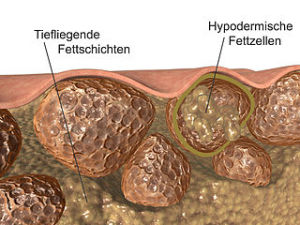 Cellulite: Fettschichten und Hypodermische_Fettzellen